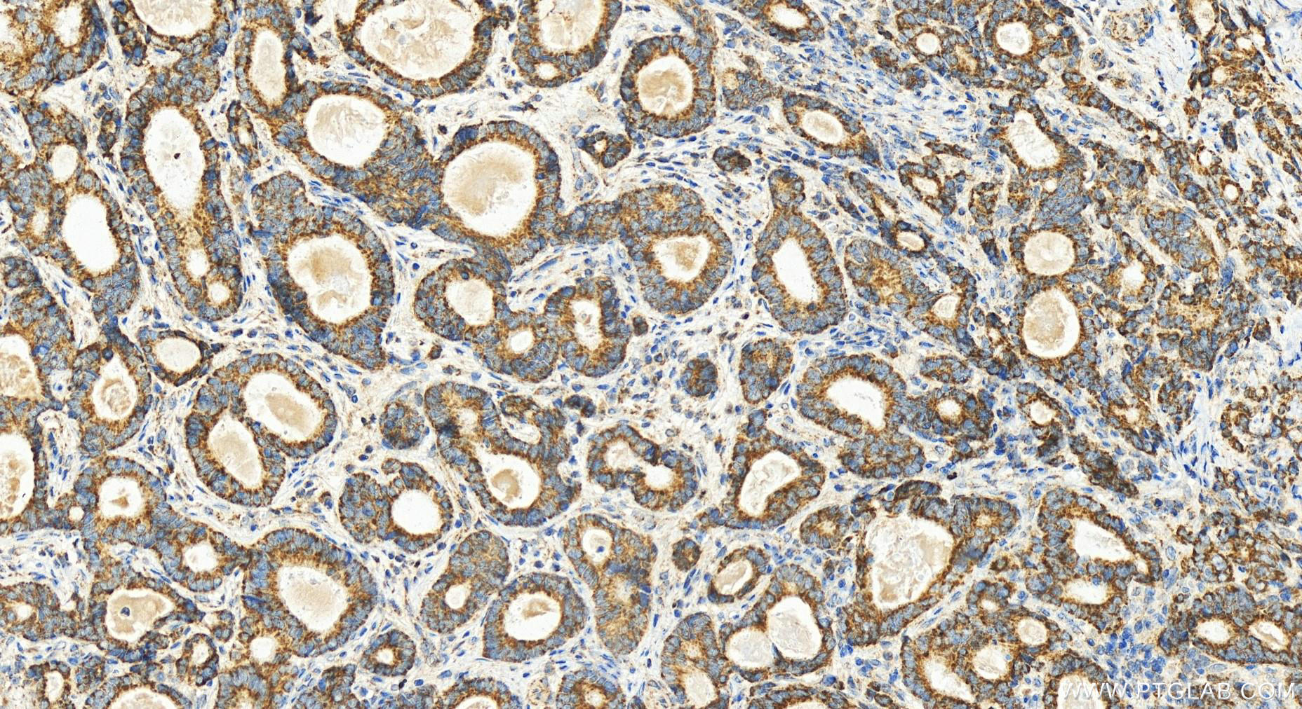 Immunohistochemistry (IHC) staining of human stomach cancer tissue using POLDIP2 Polyclonal antibody (15080-1-AP)