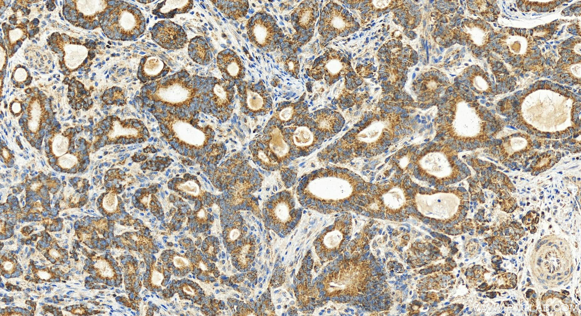 Immunohistochemistry (IHC) staining of human stomach cancer tissue using POLDIP2 Polyclonal antibody (15080-1-AP)