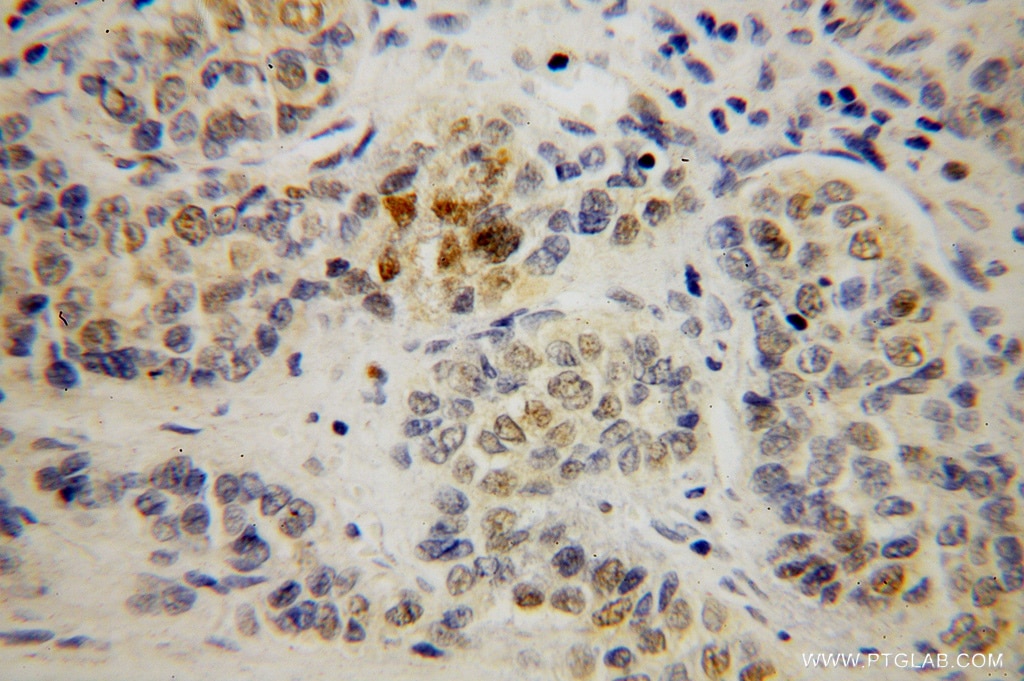 Immunohistochemistry (IHC) staining of human liver cancer tissue using POLE3 Polyclonal antibody (15278-1-AP)