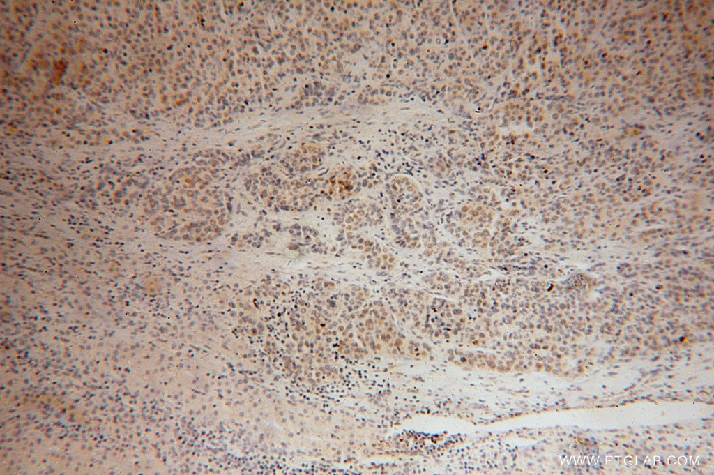Immunohistochemistry (IHC) staining of human liver cancer tissue using POLE3 Polyclonal antibody (15278-1-AP)