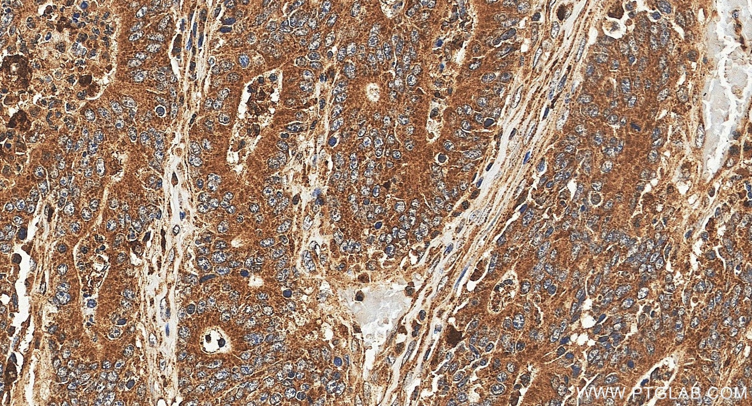 IHC staining of human colon cancer using 10997-2-AP Immunohistochemistry (IHC) staining of human colon cancer tissue using POLG2 Polyclonal antibody (10997-2-AP)