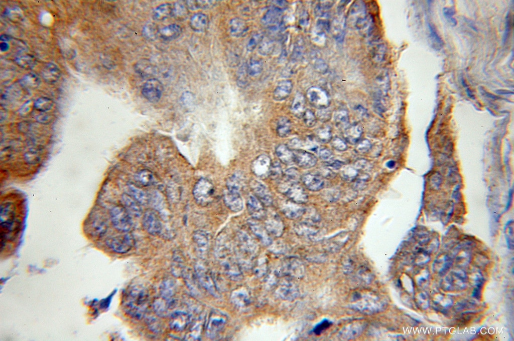 Immunohistochemistry (IHC) staining of human colon cancer tissue using POLG2 Polyclonal antibody (10997-2-AP)