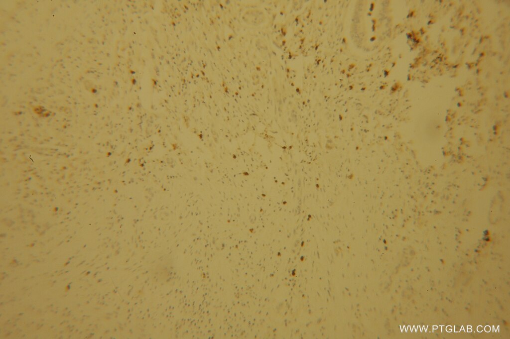 Immunohistochemistry (IHC) staining of human pancreas cancer tissue using POLI Polyclonal antibody (13635-1-AP)