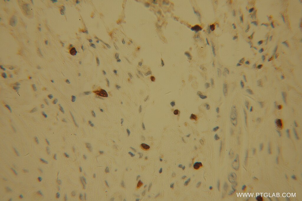 Immunohistochemistry (IHC) staining of human pancreas cancer tissue using POLI Polyclonal antibody (13635-1-AP)