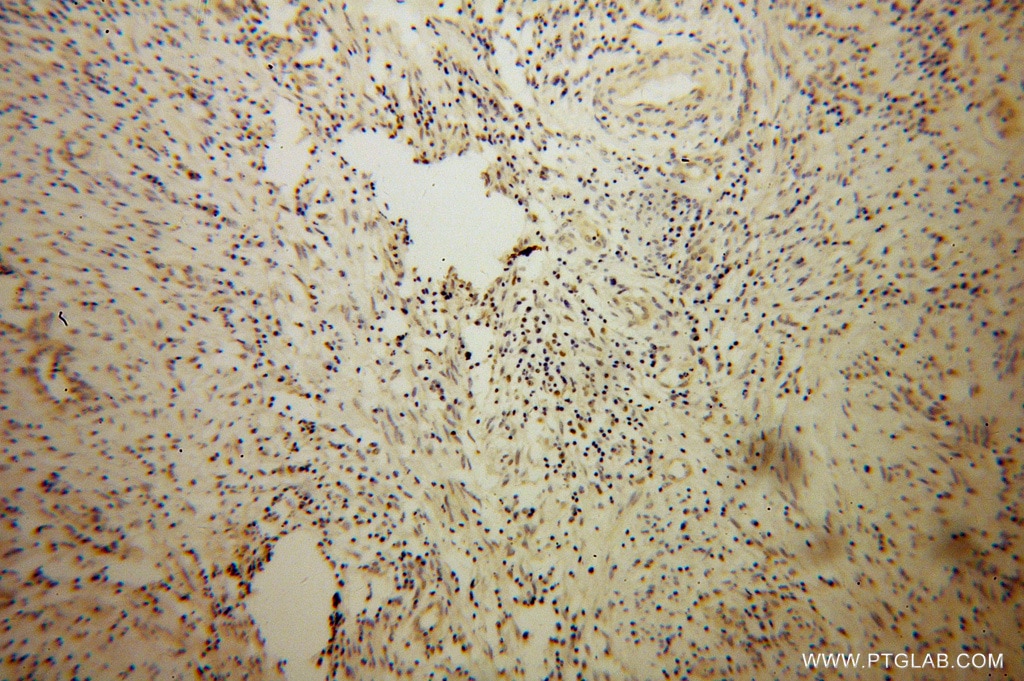 IHC staining of human cervical cancer using 14455-1-AP