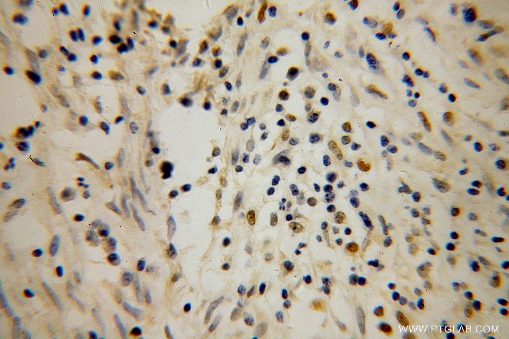 IHC staining of human cervical cancer using 14455-1-AP