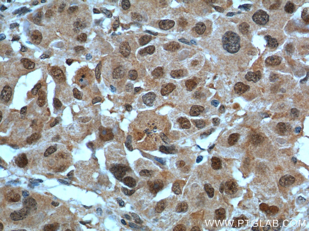 Immunohistochemistry (IHC) staining of human liver cancer tissue using POLR1E Polyclonal antibody (16145-1-AP)