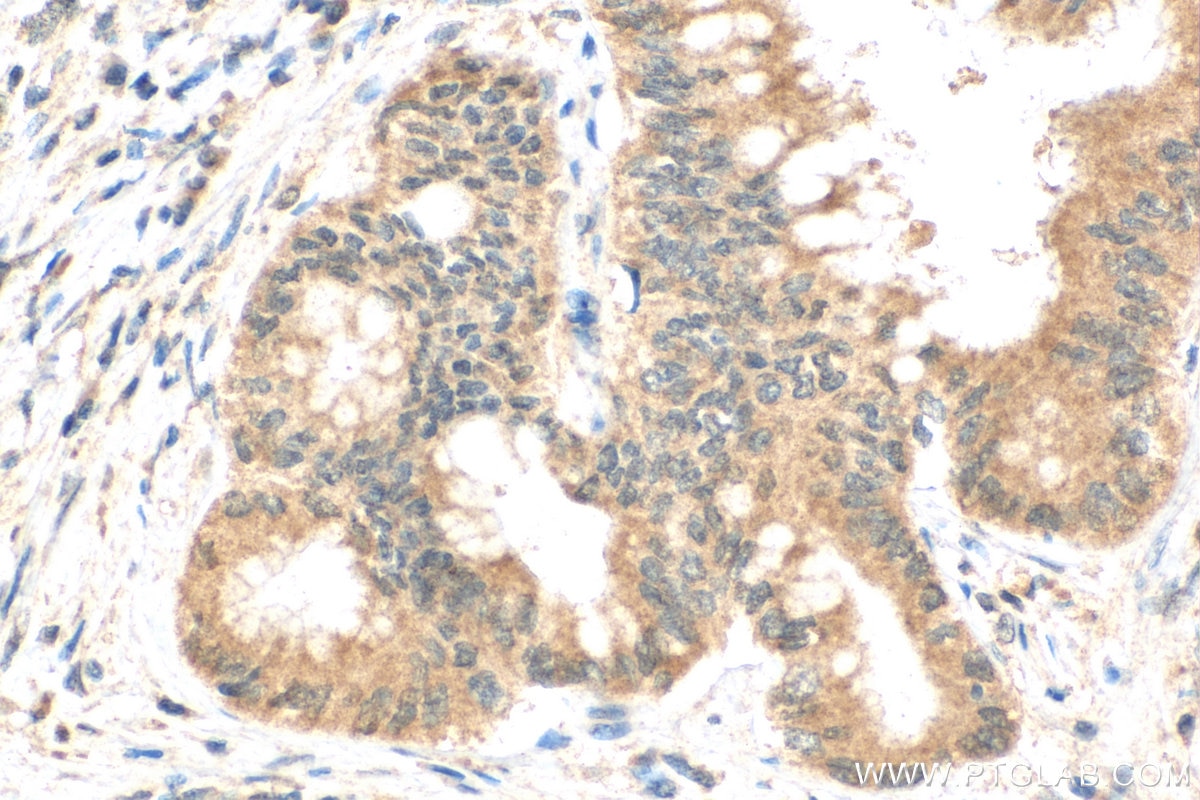 Immunohistochemistry (IHC) staining of human pancreas cancer tissue using POLR2A Polyclonal antibody (20655-1-AP)