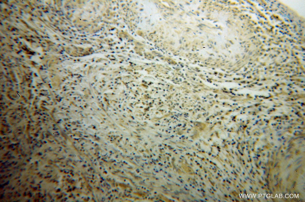 Immunohistochemistry (IHC) staining of human cervical cancer tissue using POLR2C Polyclonal antibody (13428-1-AP)