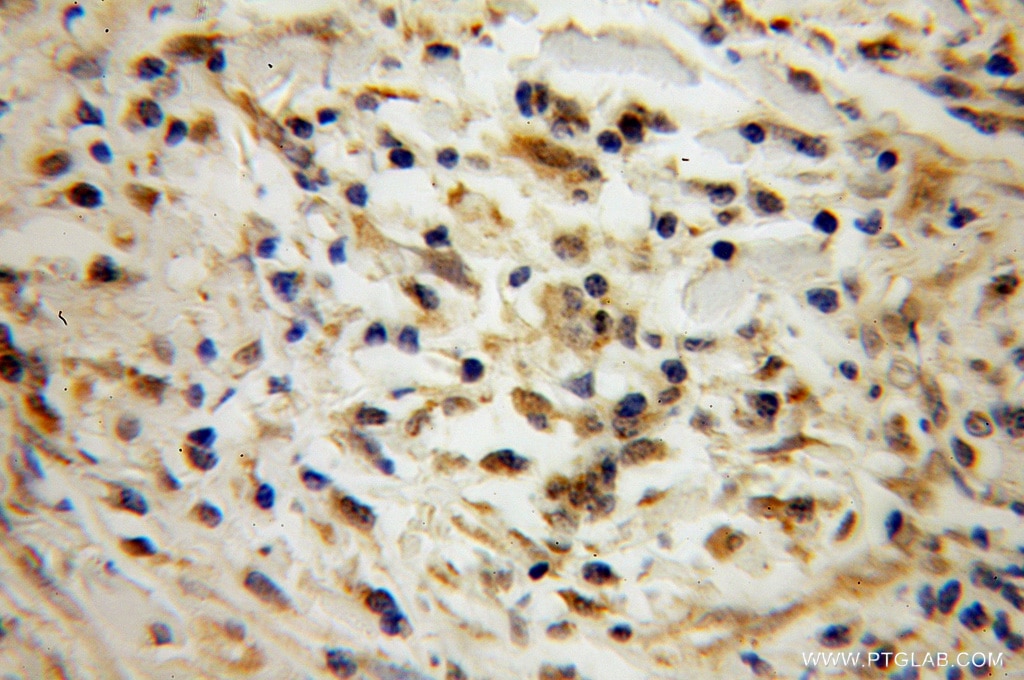 Immunohistochemistry (IHC) staining of human cervical cancer tissue using POLR2C Polyclonal antibody (13428-1-AP)