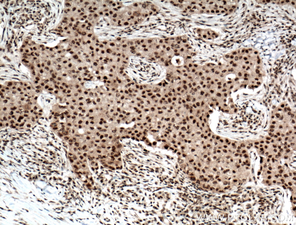 Immunohistochemistry (IHC) staining of human breast cancer tissue using RPB5 Polyclonal antibody (15217-1-AP)