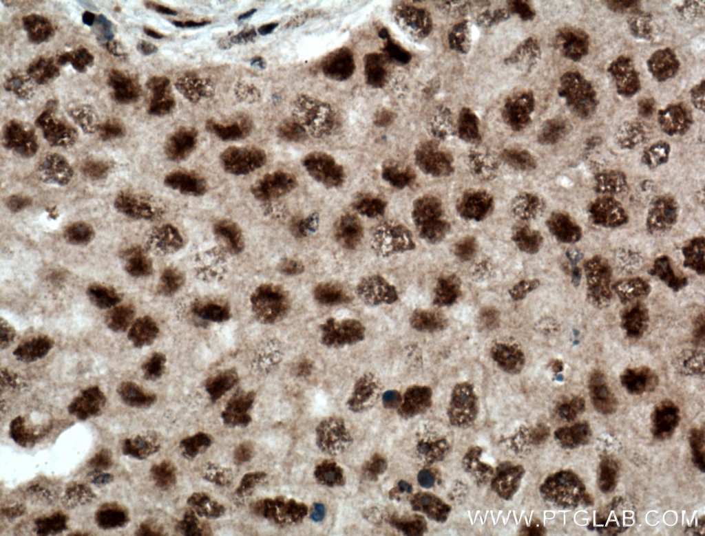 Immunohistochemistry (IHC) staining of human breast cancer tissue using RPB5 Polyclonal antibody (15217-1-AP)