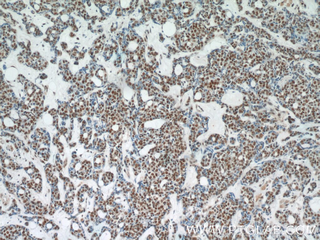 Immunohistochemistry (IHC) staining of human cervical cancer tissue using POLR2F Polyclonal antibody (15334-1-AP)