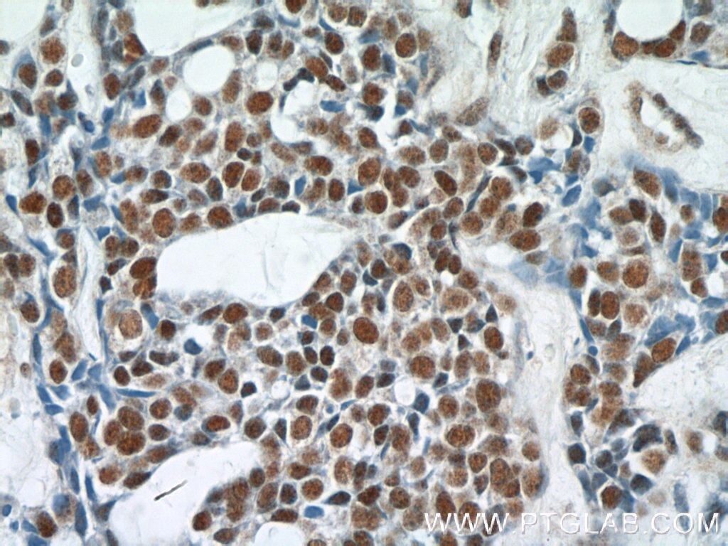 Immunohistochemistry (IHC) staining of human cervical cancer tissue using POLR2F Polyclonal antibody (15334-1-AP)