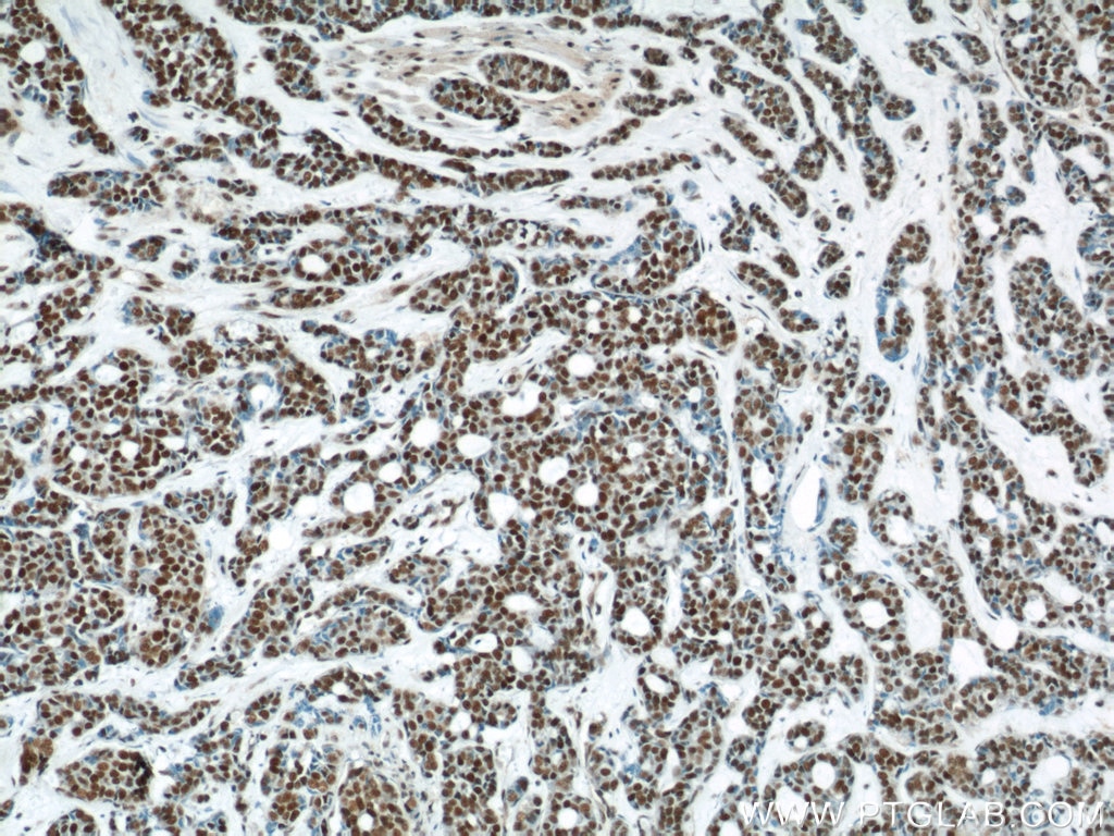 Immunohistochemistry (IHC) staining of human cervical cancer tissue using POLR2F Polyclonal antibody (15334-1-AP)