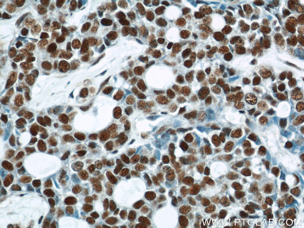 Immunohistochemistry (IHC) staining of human cervical cancer tissue using POLR2F Polyclonal antibody (15334-1-AP)