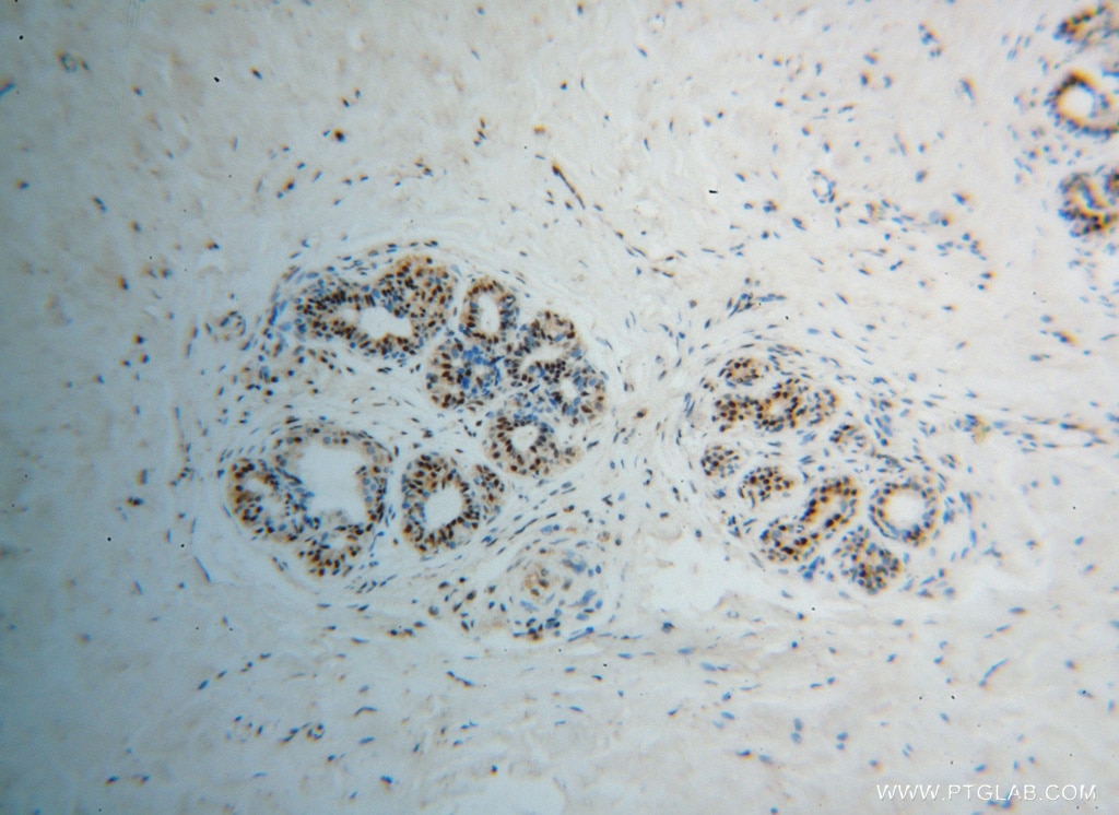 Immunohistochemistry (IHC) staining of human breast cancer tissue using POLR2H Polyclonal antibody (15086-1-AP)