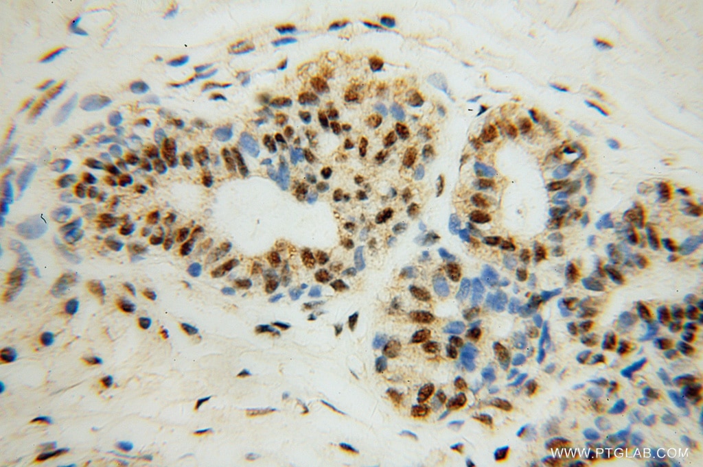 Immunohistochemistry (IHC) staining of human breast cancer tissue using POLR2H Polyclonal antibody (15086-1-AP)