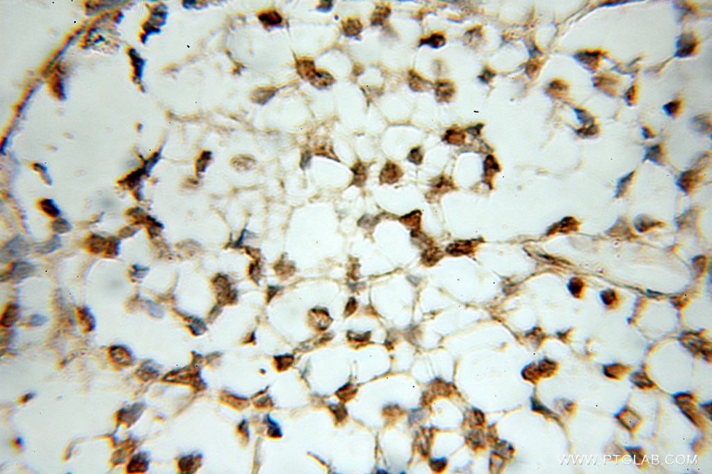 Immunohistochemistry (IHC) staining of human gliomas tissue using POLR3K Polyclonal antibody (11084-1-AP)