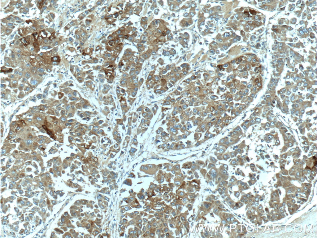 Immunohistochemistry (IHC) staining of human liver cancer tissue using PON2 Polyclonal antibody (14379-1-AP)