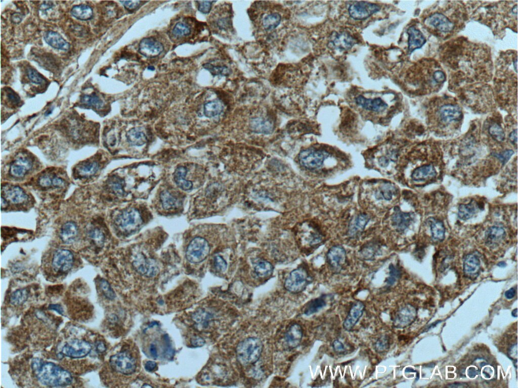 Immunohistochemistry (IHC) staining of human liver cancer tissue using PON2 Polyclonal antibody (14379-1-AP)