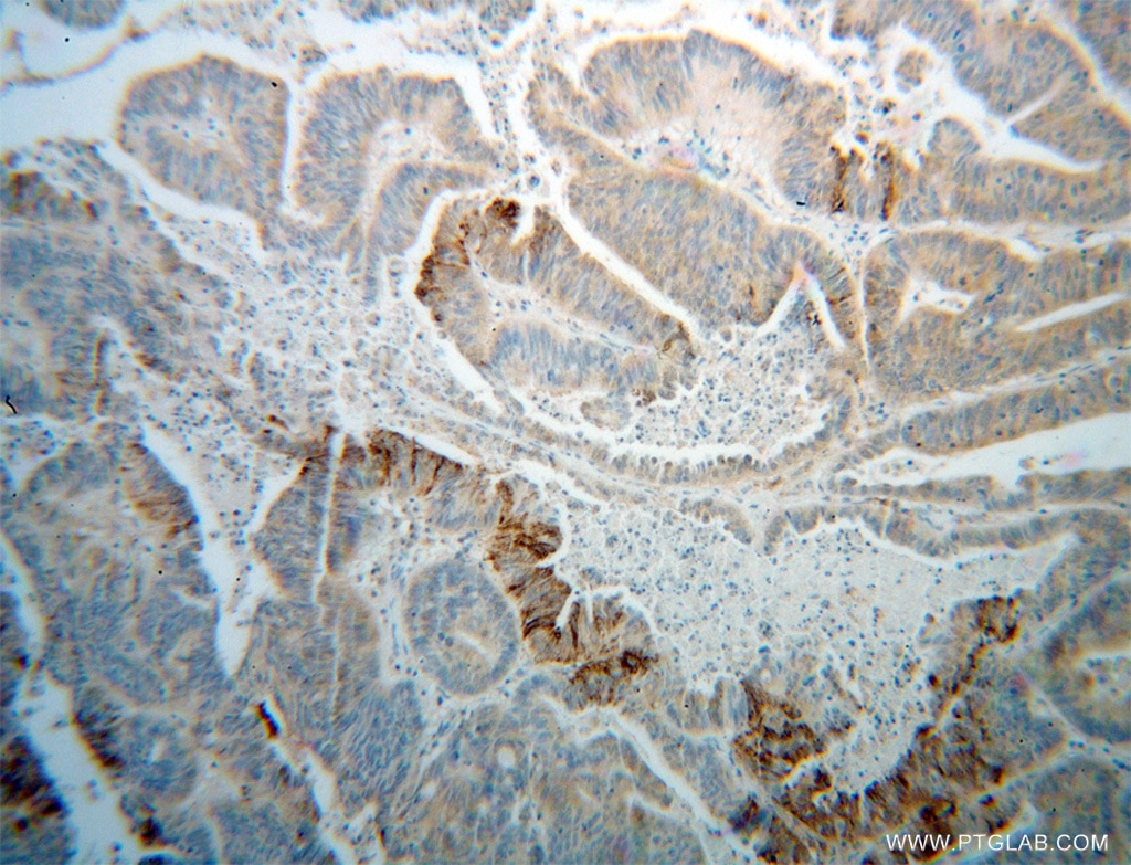 Immunohistochemistry (IHC) staining of human liver cancer tissue using PON2 Polyclonal antibody (14379-1-AP)
