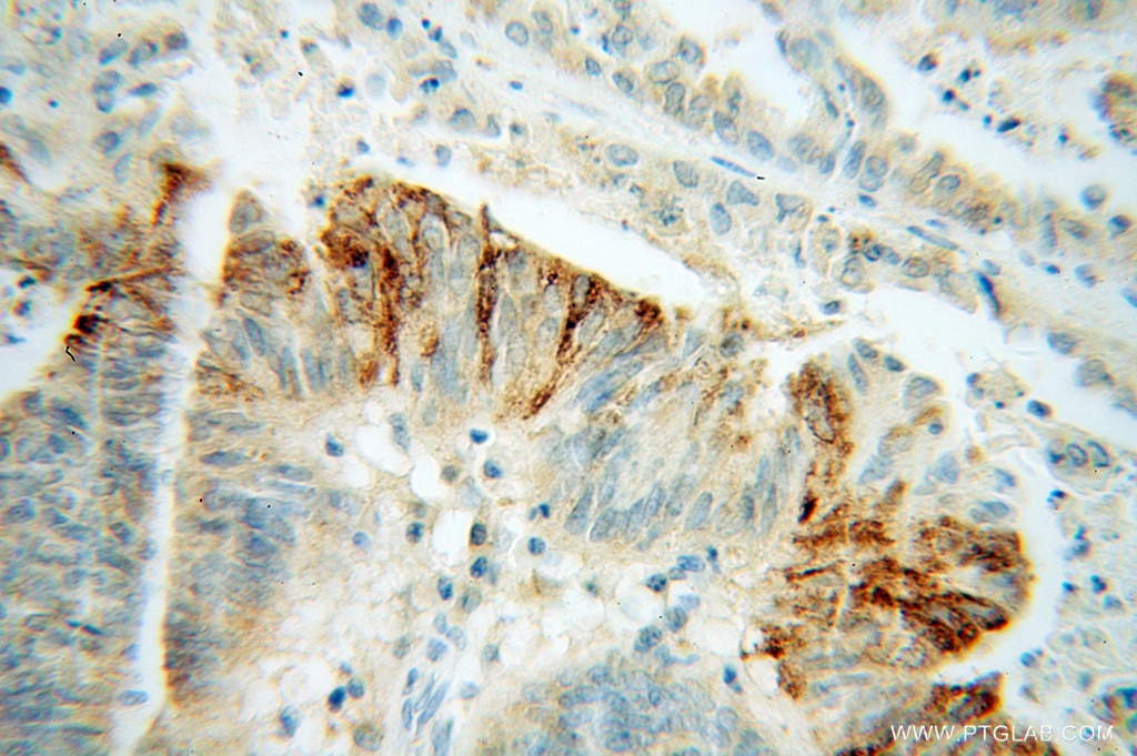 Immunohistochemistry (IHC) staining of human liver cancer tissue using PON2 Polyclonal antibody (14379-1-AP)