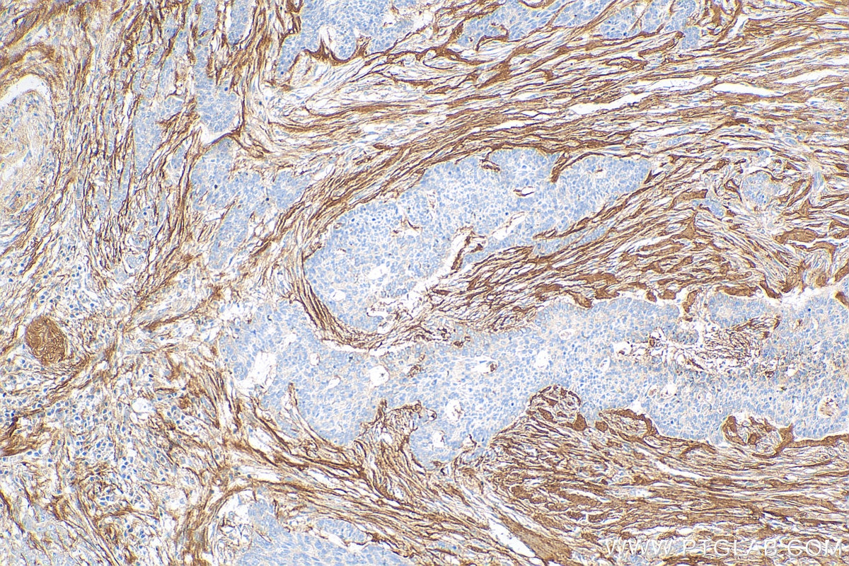 Immunohistochemistry (IHC) staining of human skin cancer tissue using Periostin Polyclonal antibody (19899-1-AP)