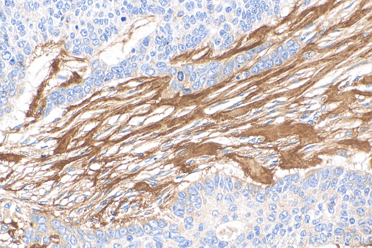 Immunohistochemistry (IHC) staining of human skin cancer tissue using Periostin Polyclonal antibody (19899-1-AP)