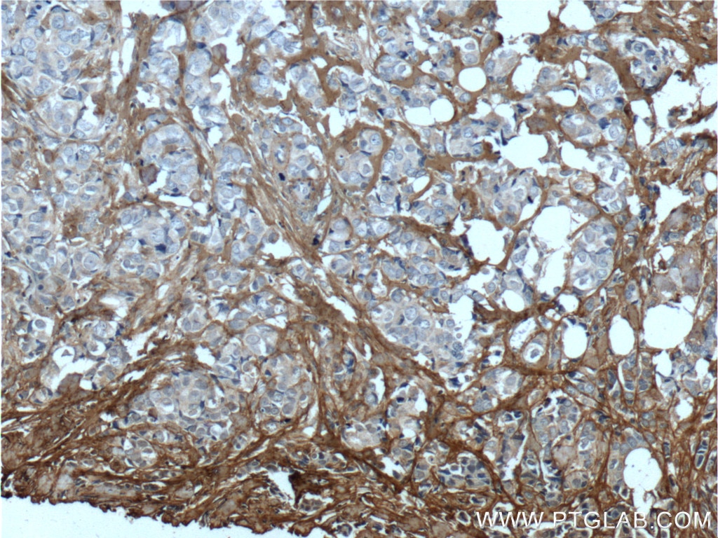 Immunohistochemistry (IHC) staining of human breast cancer tissue using Periostin Polyclonal antibody (19899-1-AP)