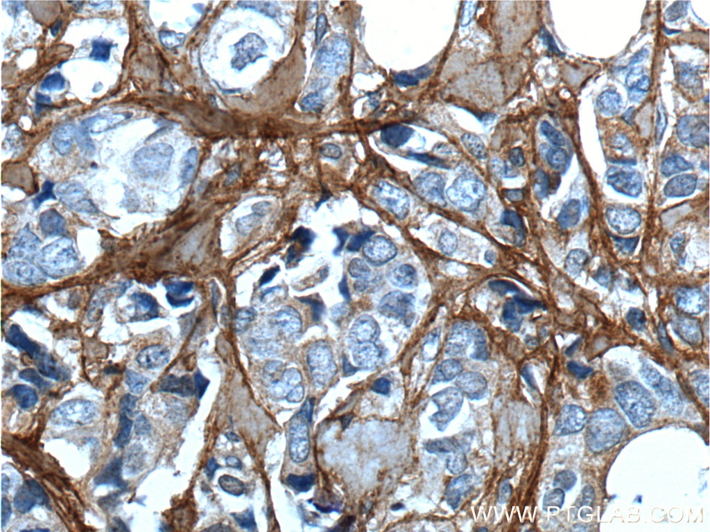 Immunohistochemistry (IHC) staining of human breast cancer tissue using Periostin Polyclonal antibody (19899-1-AP)