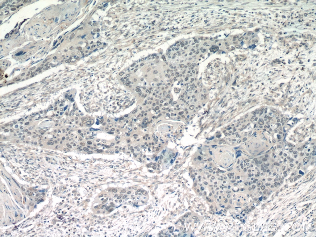 Immunohistochemistry (IHC) staining of human cervical cancer tissue using POT1 Polyclonal antibody (10581-1-AP)