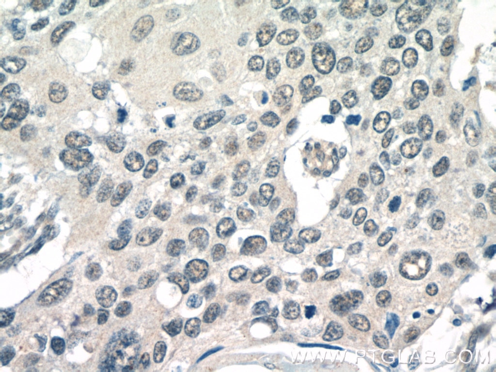 IHC staining of human cervical cancer using 10581-1-AP