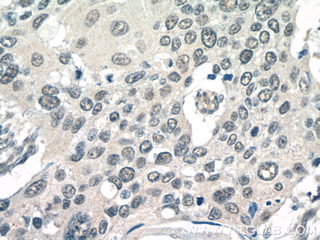 Immunohistochemistry (IHC) staining of human cervical cancer tissue using POT1 Polyclonal antibody (10581-1-AP)