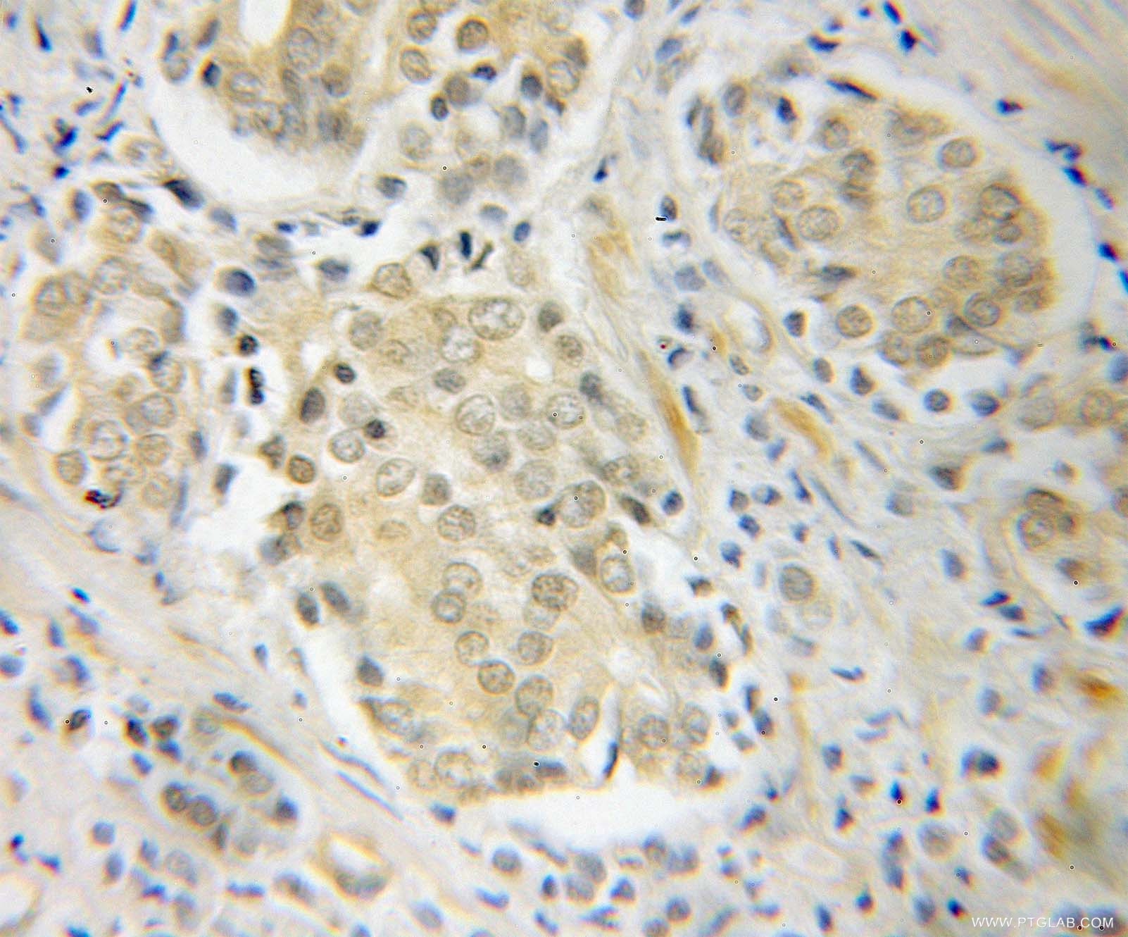 Immunohistochemistry (IHC) staining of human prostate cancer tissue using POT1 Polyclonal antibody (10581-1-AP)