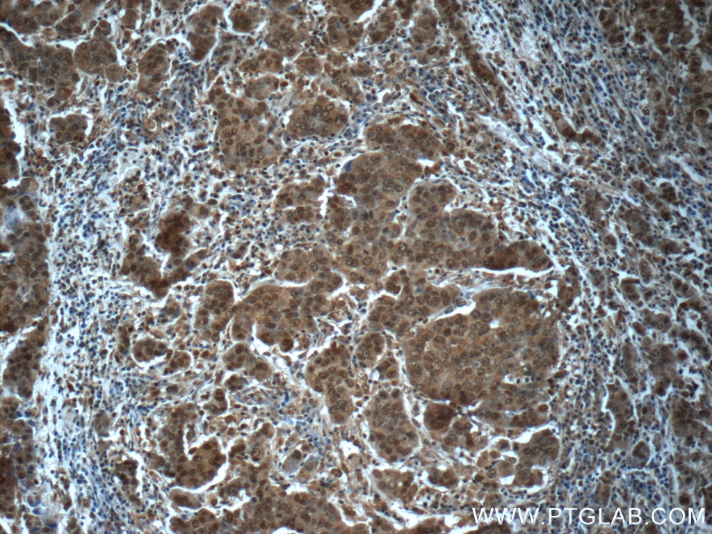 IHC staining of human prostate cancer using 24593-1-AP