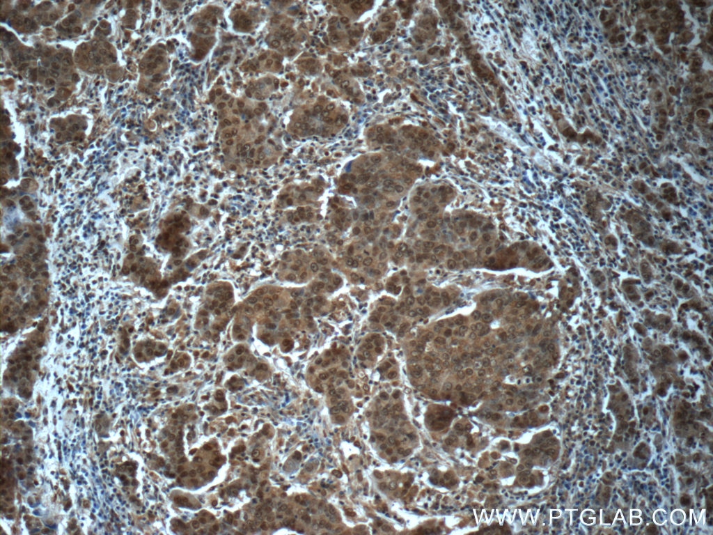 Immunohistochemistry (IHC) staining of human prostate cancer tissue using POTEA Polyclonal antibody (24593-1-AP)