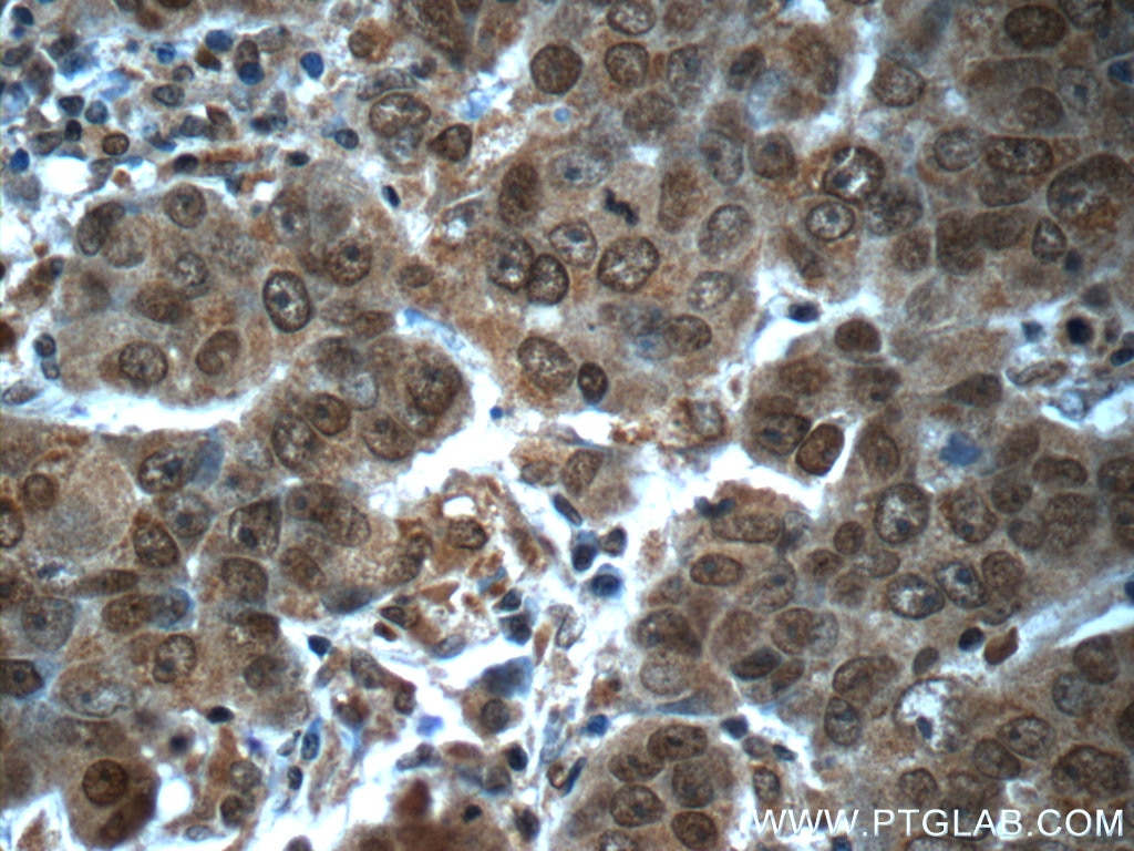 Immunohistochemistry (IHC) staining of human prostate cancer tissue using POTEA Polyclonal antibody (24593-1-AP)
