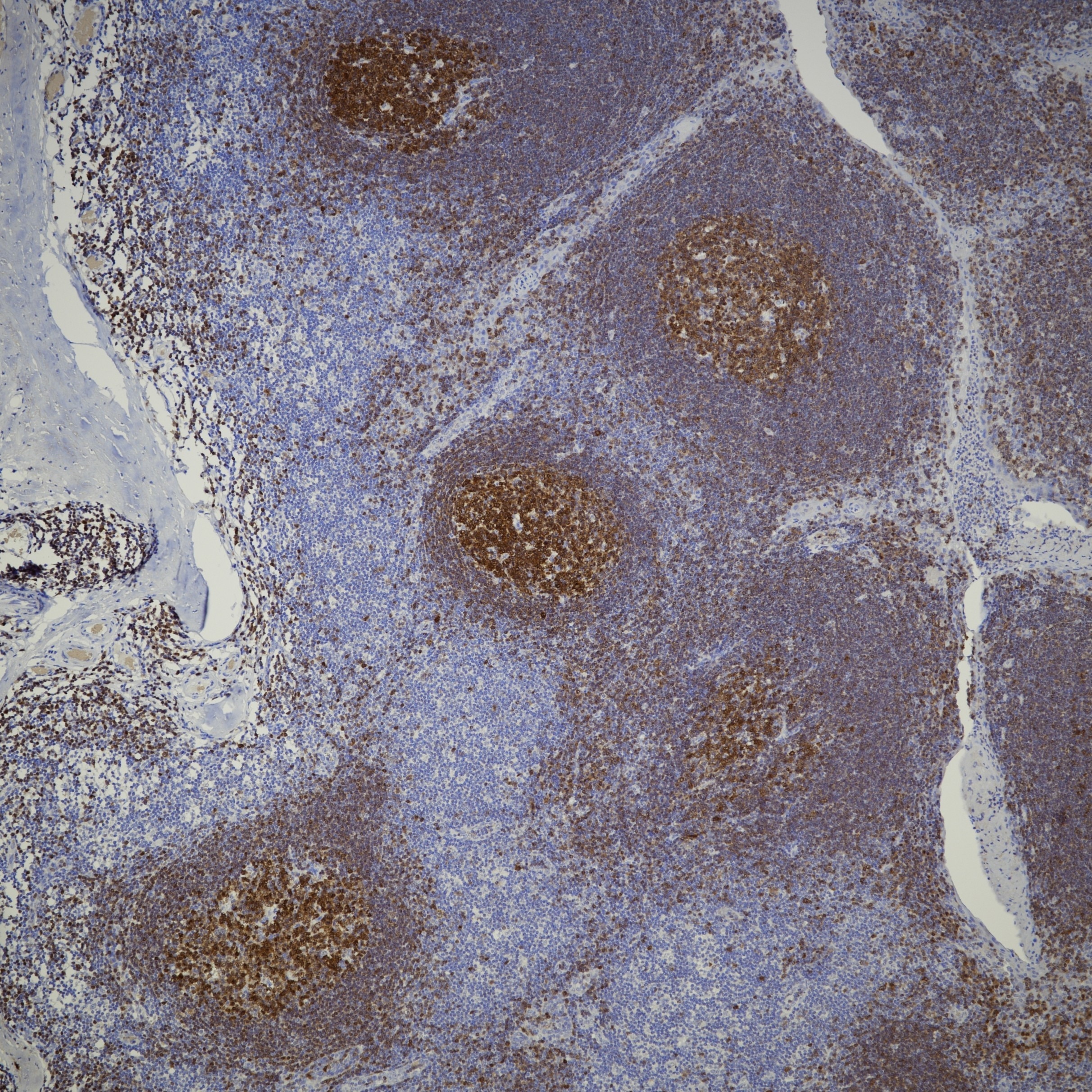 IHC staining of human tonsil using 66659-1-Ig Immunohistochemistry (IHC) staining of human tonsil tissue using POU2AF1 Monoclonal antibody (66659-1-Ig)