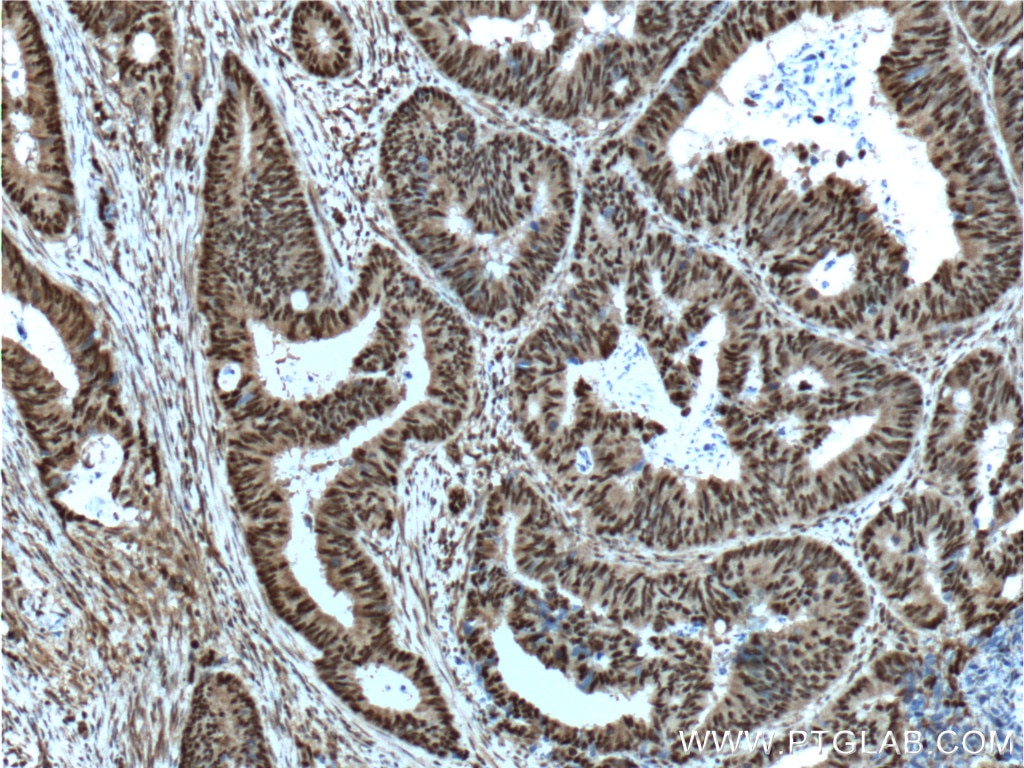 Immunohistochemistry (IHC) staining of human colon cancer tissue using OCT1 Polyclonal antibody (10387-1-AP)