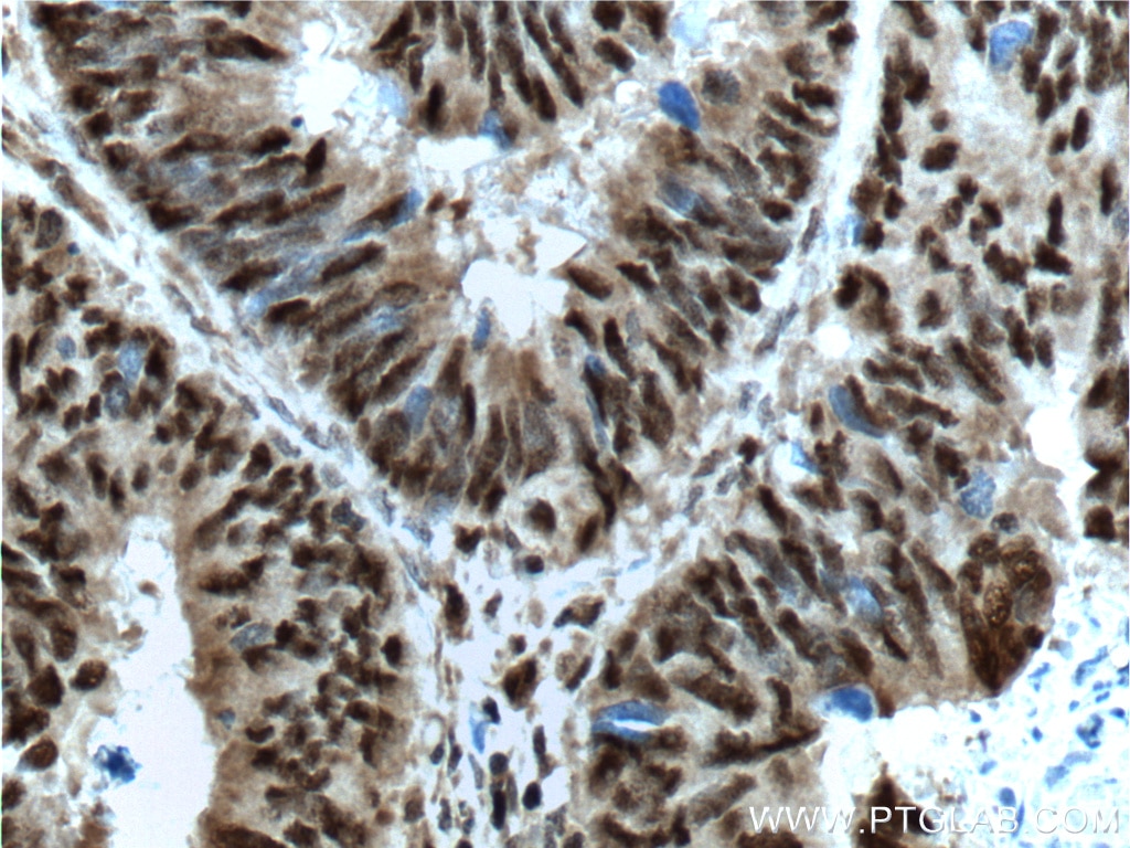 Immunohistochemistry (IHC) staining of human colon cancer tissue using OCT1 Polyclonal antibody (10387-1-AP)