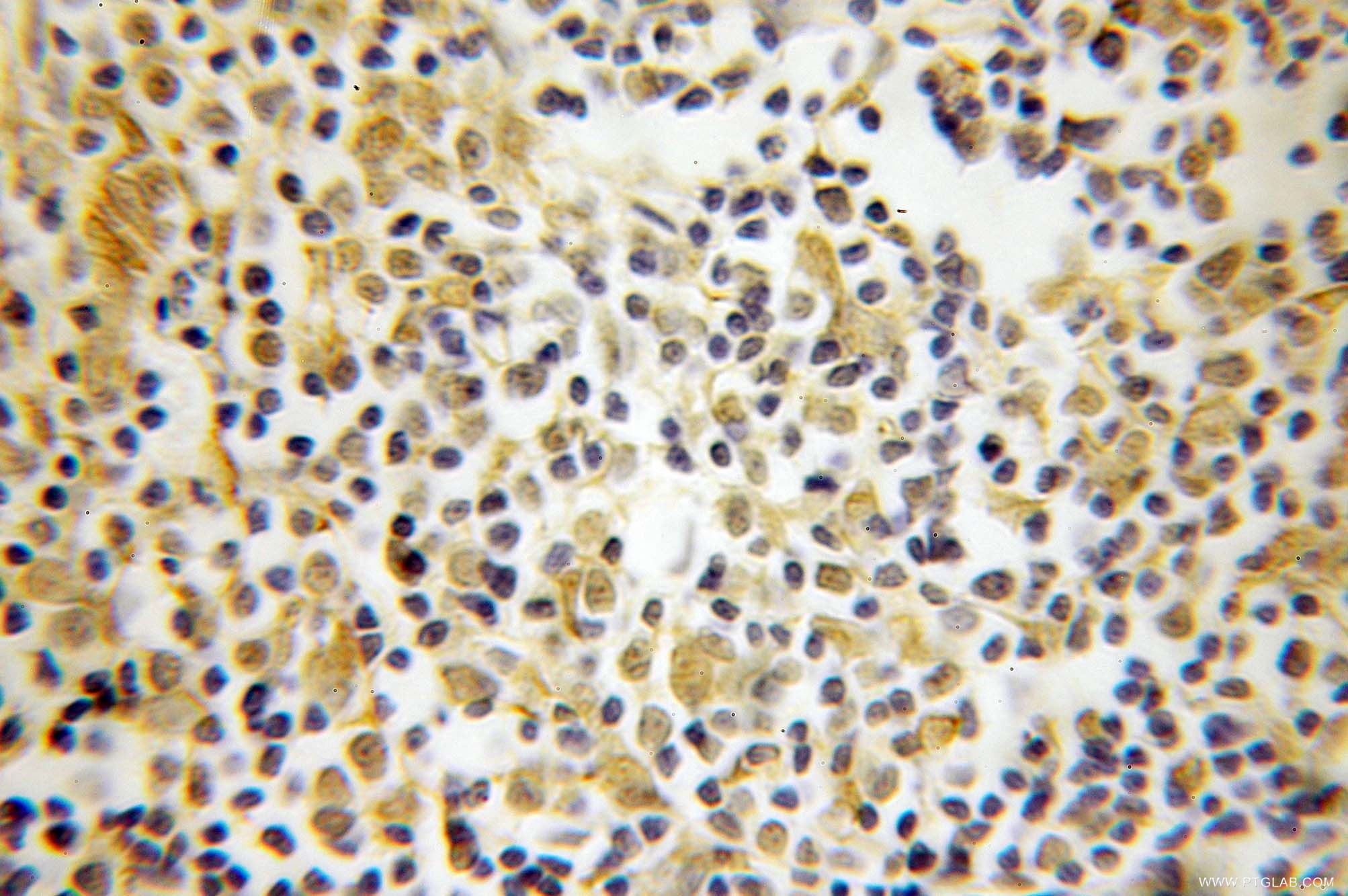 Immunohistochemistry (IHC) staining of human lymphoma tissue using OCT1 Polyclonal antibody (10387-1-AP)