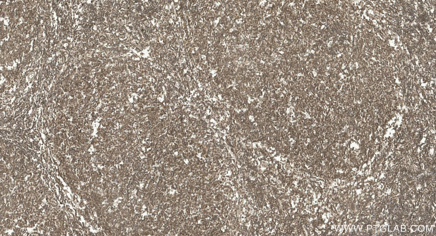 Immunohistochemistry (IHC) staining of human lymphoma tissue using OCT2/POU2F2 Polyclonal antibody (10867-2-AP)