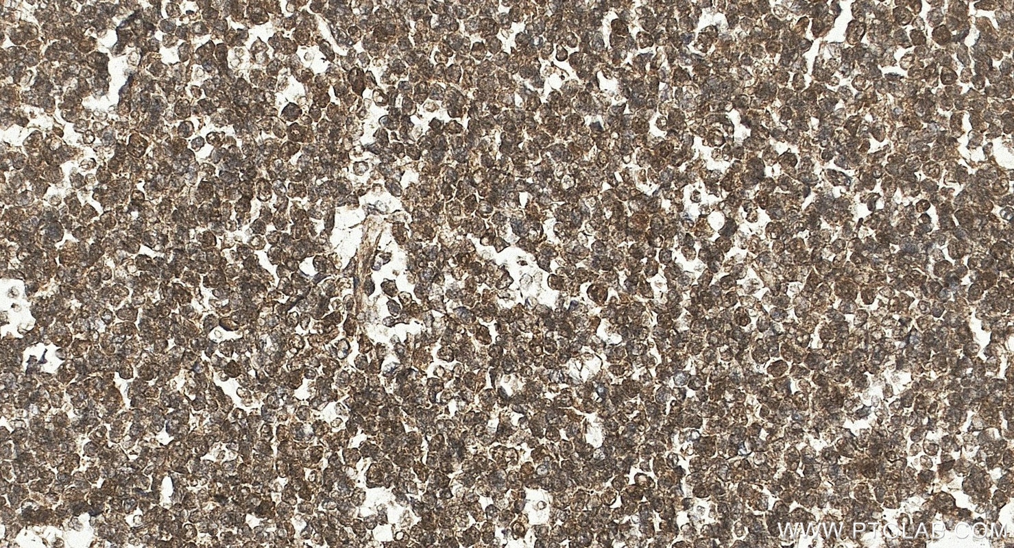 Immunohistochemistry (IHC) staining of human lymphoma tissue using OCT2/POU2F2 Polyclonal antibody (10867-2-AP)