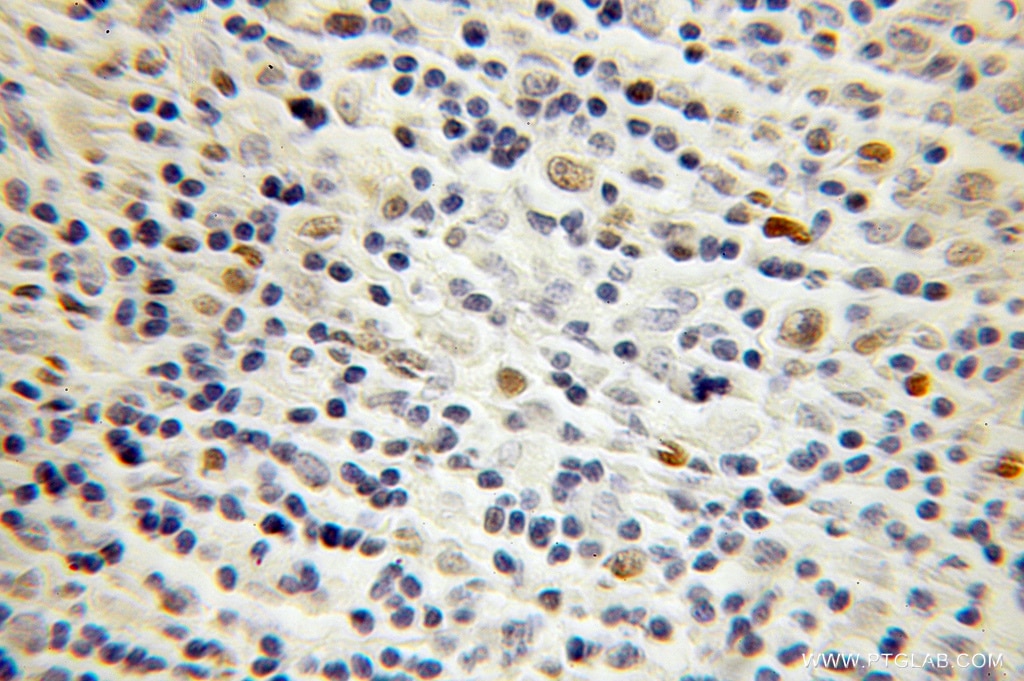 Immunohistochemistry (IHC) staining of human lymphoma tissue using OCT2 Polyclonal antibody (10867-2-AP)