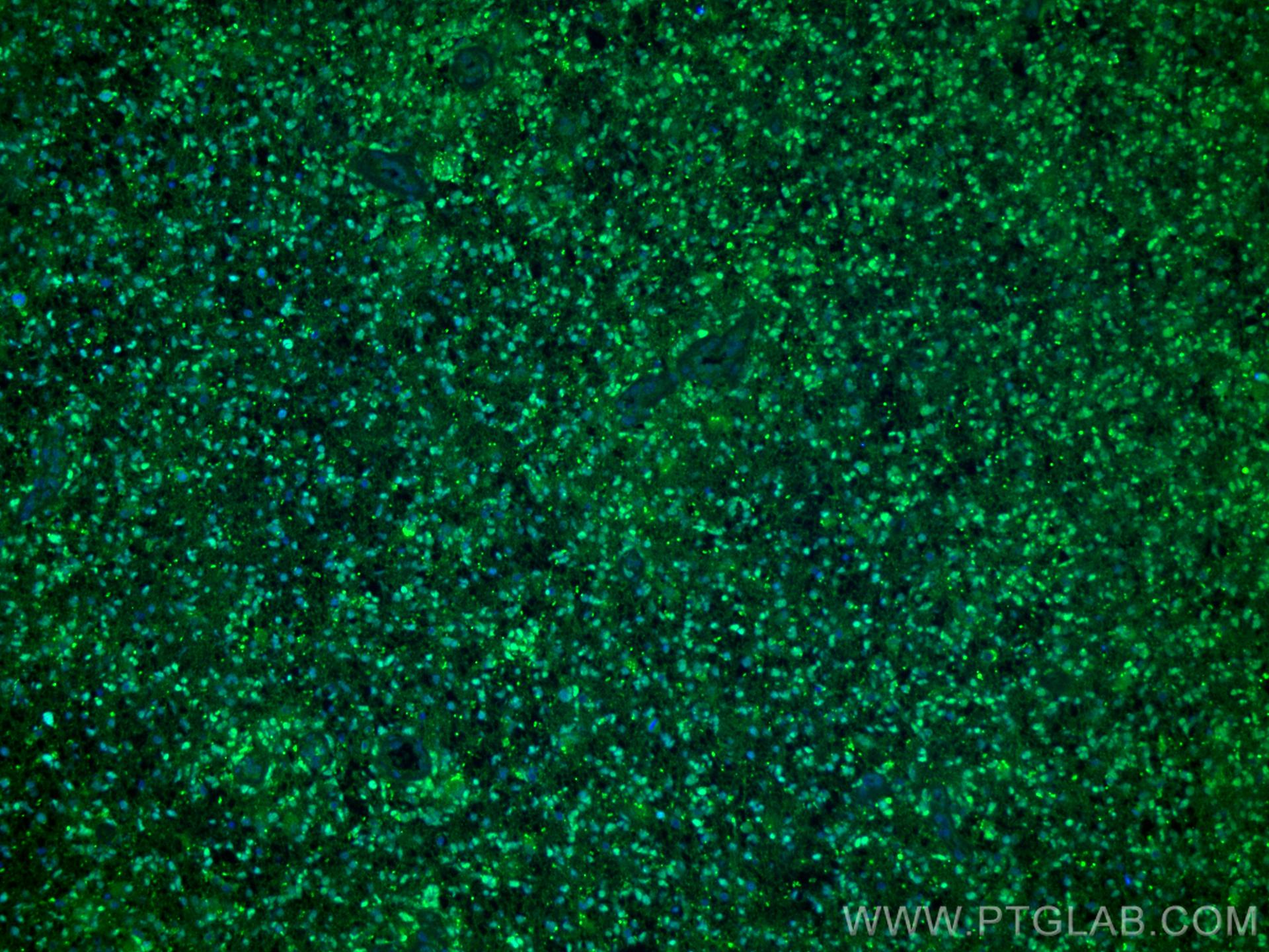 Immunofluorescence (IF) / fluorescent staining of human gliomas tissue using BRN2 Polyclonal antibody (14596-1-AP)