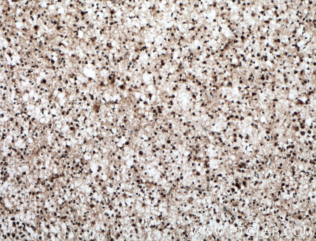 Immunohistochemistry (IHC) staining of human gliomas tissue using BRN2 Polyclonal antibody (14596-1-AP)