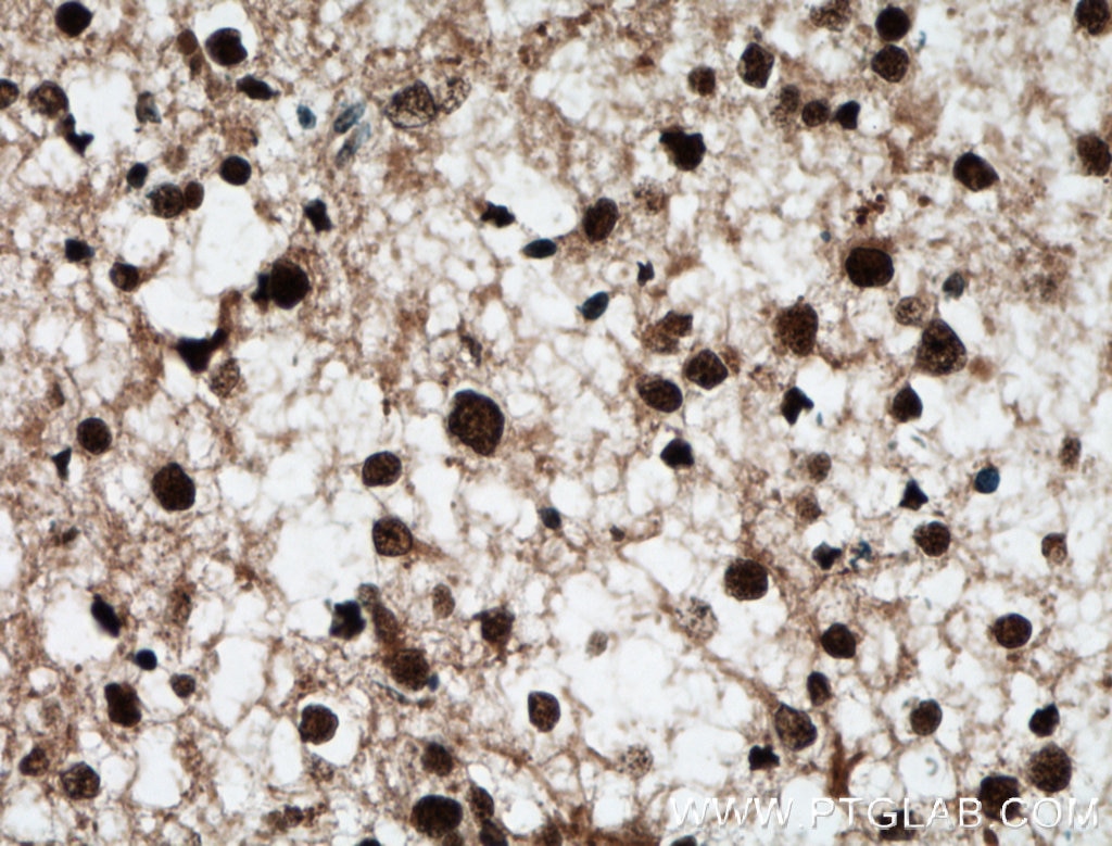Immunohistochemistry (IHC) staining of human gliomas tissue using BRN2 Polyclonal antibody (14596-1-AP)
