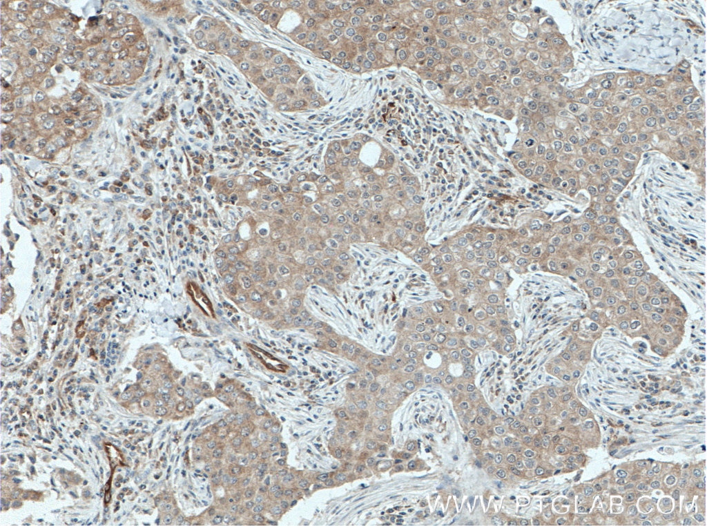 Immunohistochemistry (IHC) staining of human breast cancer tissue using PPA1 Polyclonal antibody (14985-1-AP)