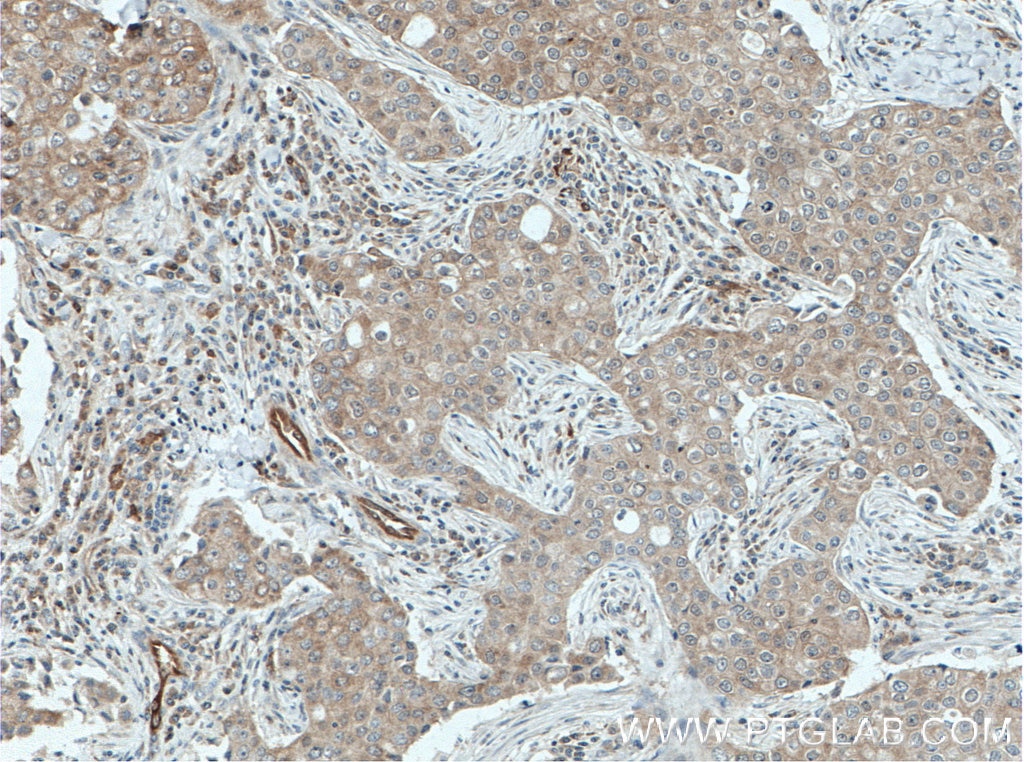 IHC staining of human breast cancer using 14985-1-AP